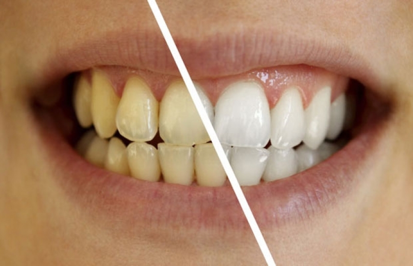 Diş beyazlığına doğal çözüm