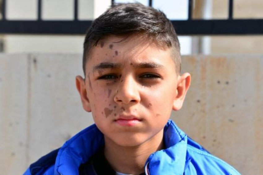 11 yaşındaki Yiğit Ali Yılmaz’ın yüzü yandı