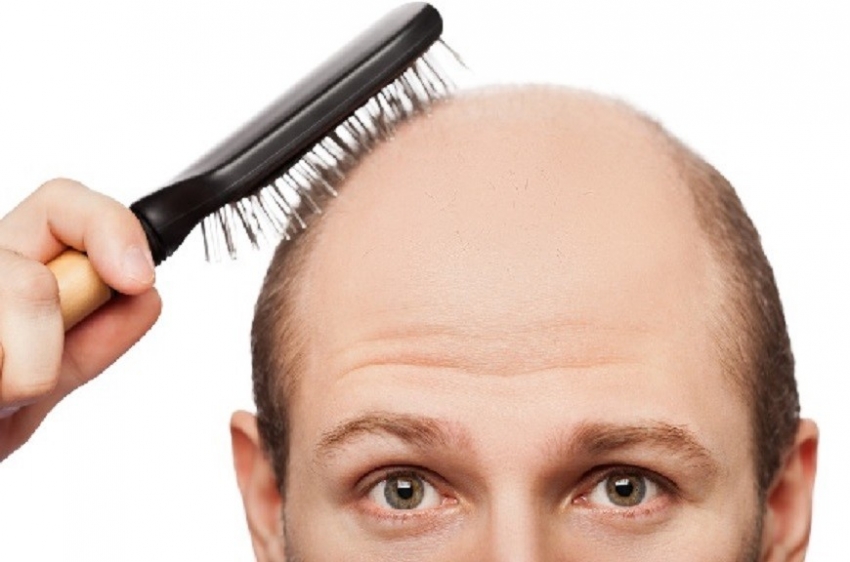 Uzmanlardan 'saç ektirmek anlık bir karar olmamalı' uyarısı 