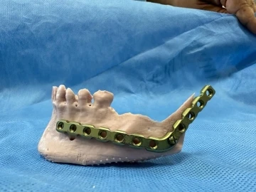 3D modelleme üzerinde test yapıldı, ardından hastaya uygulandı
