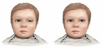 Bebeklerde göz kapağı düşüklüğü erken müdahaleyle onarılabilir
